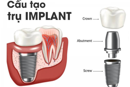 Implant nha khoa là gì? Tại sao thực hiện cấy ghép Implant?