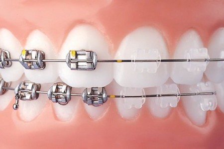Khi nào nên gặp bác sĩ chỉnh nha?