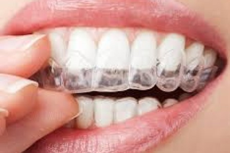 Khi nào nên tẩy trắng răng?