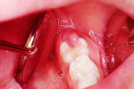 Làm gì khi bị sưng nướu răng trong cùng hàm dưới?