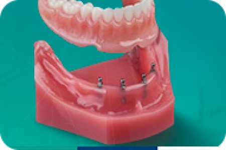 Mini Implant