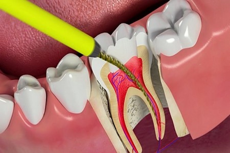 Nguyên tắc điều trị và quy trình lấy tủy răng