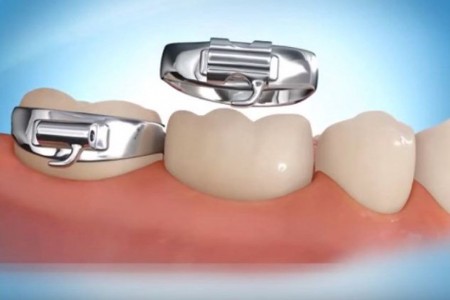 Những điều cần biết về các khí cụ khi niềng răng