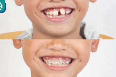 Niềng răng tăng trưởng cho trẻ em bố mẹ cần biết