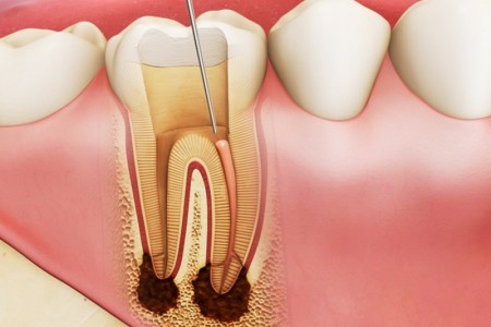 PHƯƠNG PHÁP HỖ TRỢ ĐIỀU TRỊ VIÊM TỦY RĂNG TẠI NHÀ