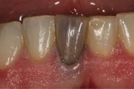 Răng chết tủy đổi màu có làm sáng được không?