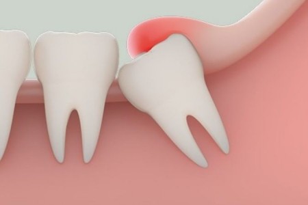 Răng khôn là gì? Những kiến thức cần biết khi nhổ răng khôn