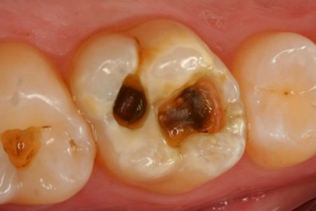 Răng sâu lâu ngày vào tủy dẫn đến viêm tủy và các biến chứng nên điều trị thế nào?