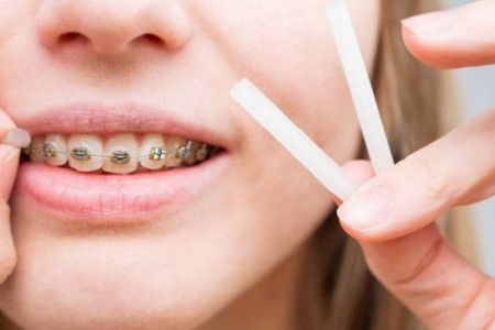 Sáp nha khoa là gì? Tác dụng và cách dùng chính xác