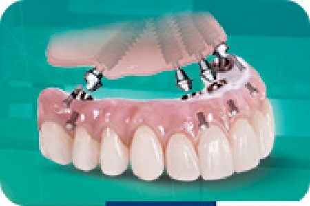 Implant Toàn Hàm 4 Trụ