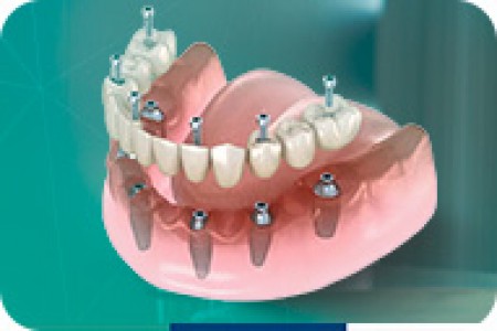 Implant Toàn Hàm 6 trụ