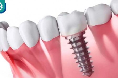 Trồng Răng Giả Có Ảnh Hưởng Gì Tới Sức Khỏe Không?