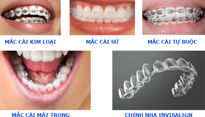 Các phương pháp chỉnh nha hiện đại