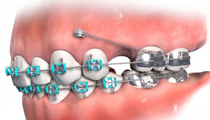 Cắm minivis niềng răng là gì?