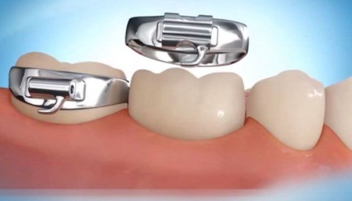 Những điều cần biết về các khí cụ khi niềng răng